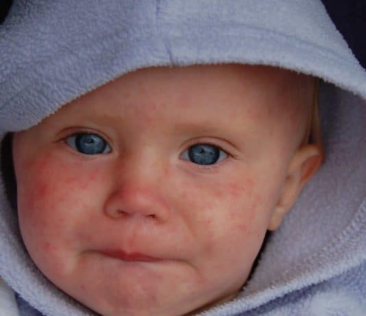 Visage d'enfant avec boutons dûs à la rougeole.