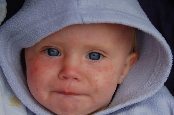 Visage d'enfant avec boutons dûs à la rougeole.